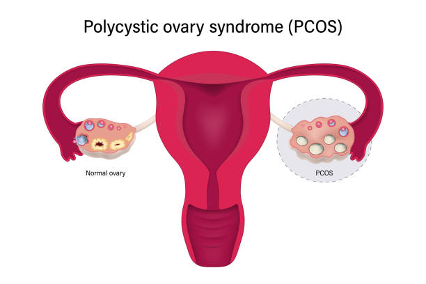 PCOS Management